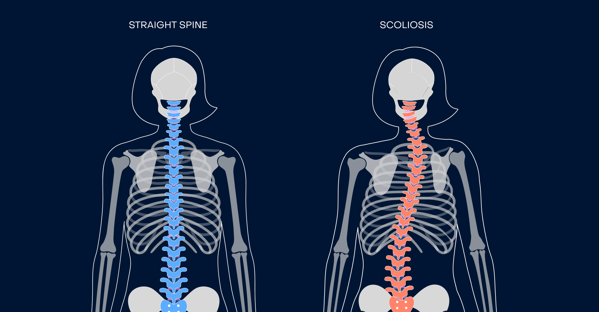 Can Scoliosis Cause Sciatica?