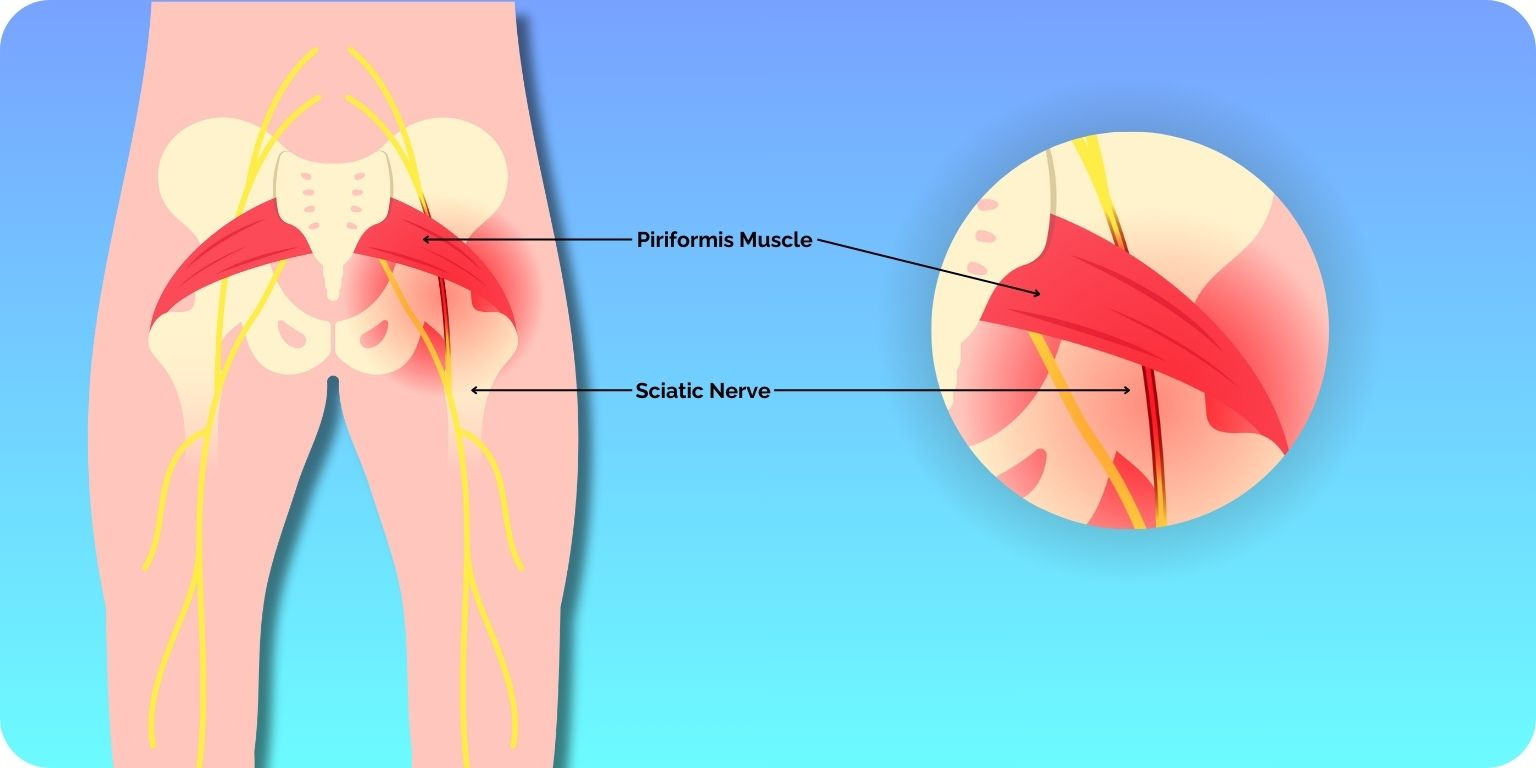 Relieve Sciatica Pain with the Modified Piriformis Stretch